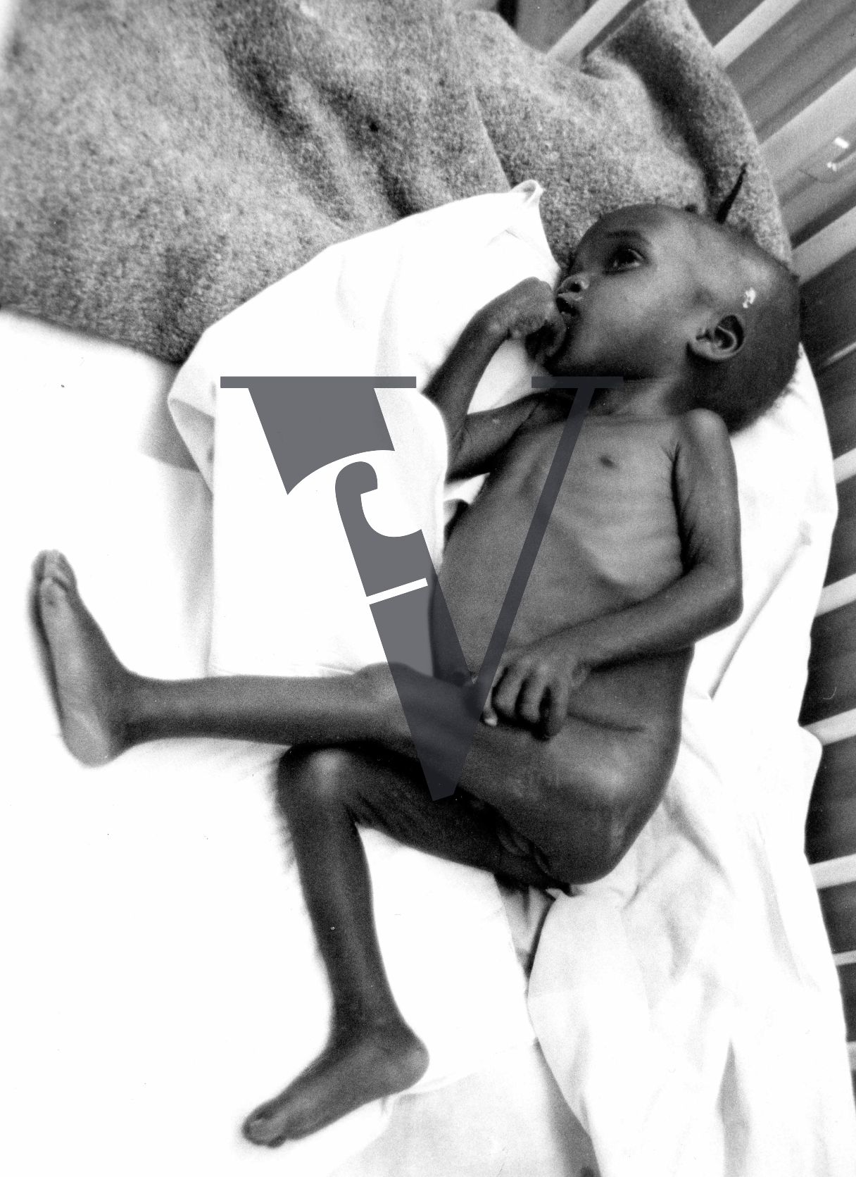 Zululand, hospital, boy, malnutrition.